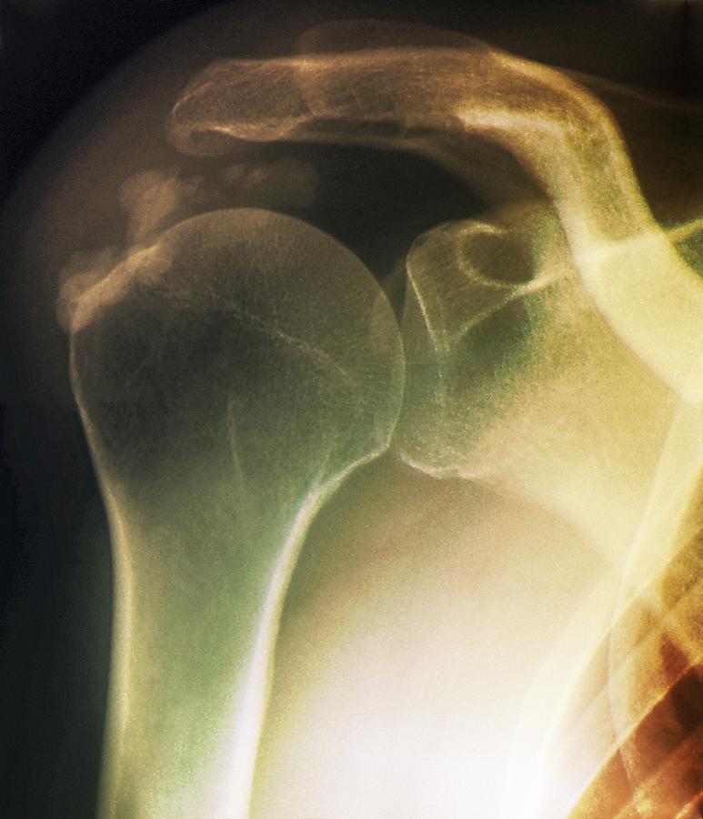 Black Background Photograph - Tendinitis Of The Shoulder, X-ray by Zephyr