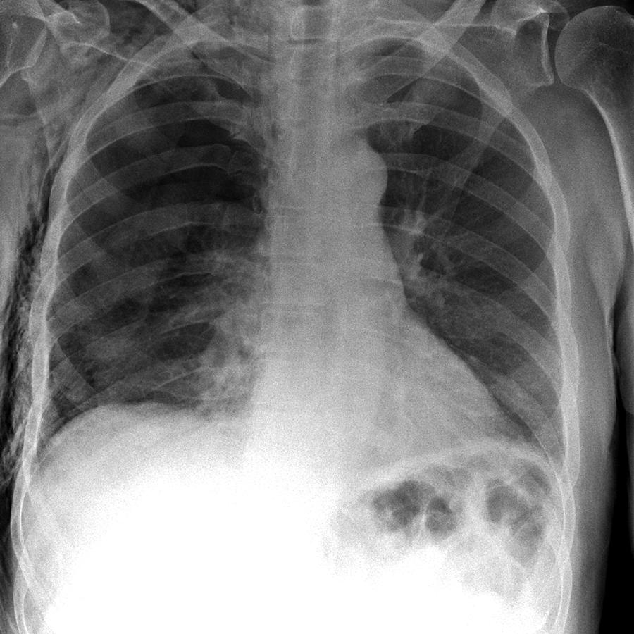 Pneumothorax Chest X Ray