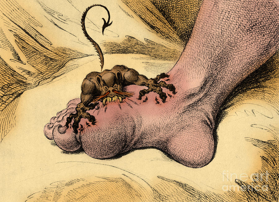 The Gout Photograph by Science Source
