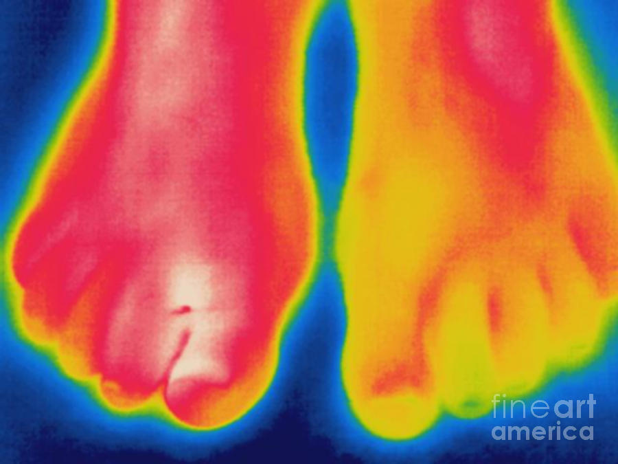 Thermogram Of An Infected Toe Photograph by Ted Kinsman