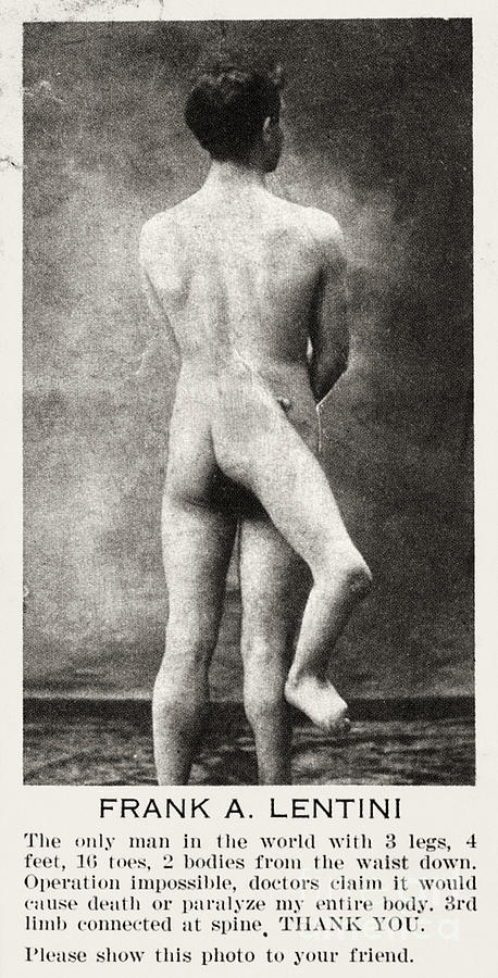 THREE-LEGGED MAN c1915 Photograph by Granger