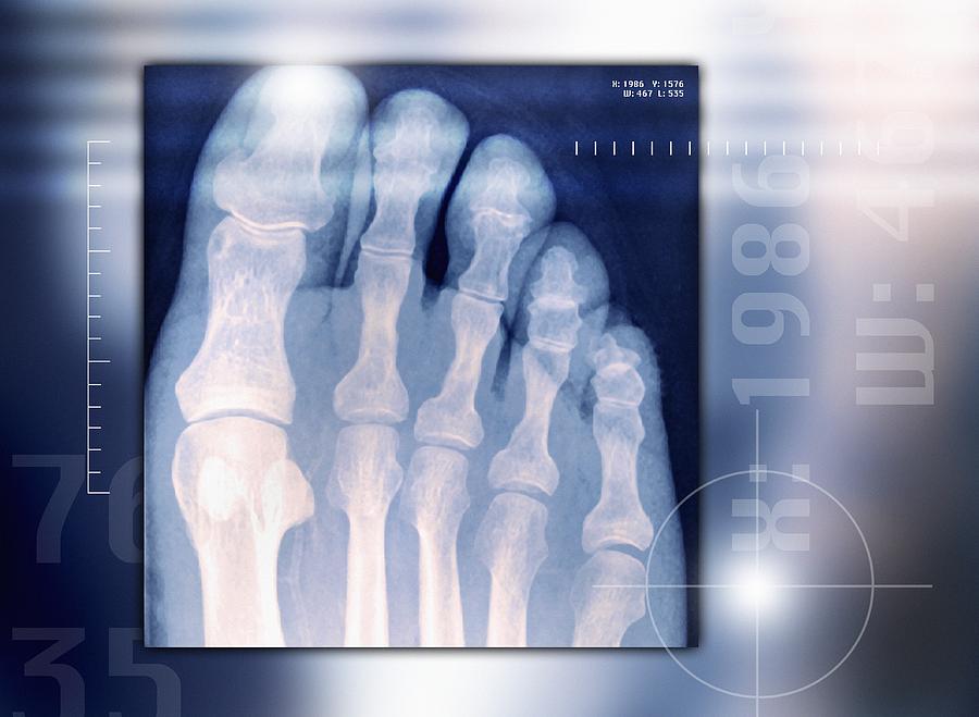 Toes, X-ray Photograph by Miriam Maslo | Fine Art America