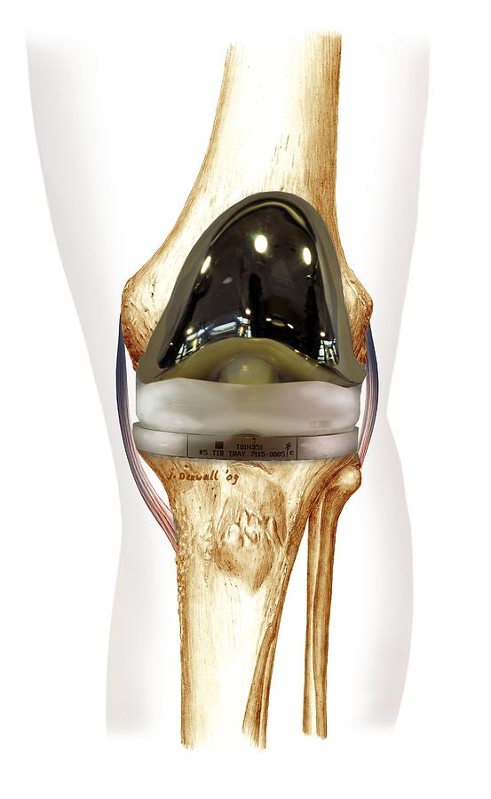 Total Knee Replacement Photograph - Total Knee Replacement, Artwork by D & L Graphics