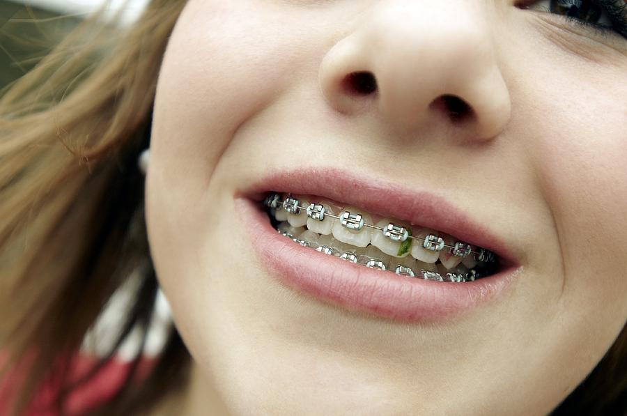 Trapped Food In Dental Braces Photograph By Tony Mcconnell Pixels