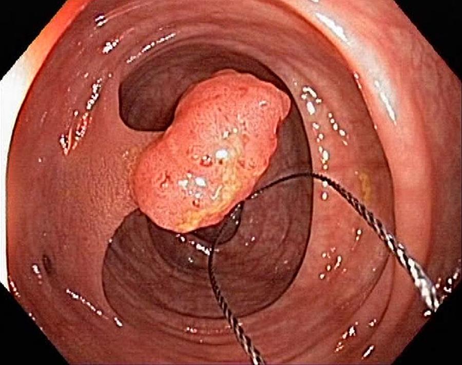 Tubular Polyp In The Colon Photograph by Gastrolab