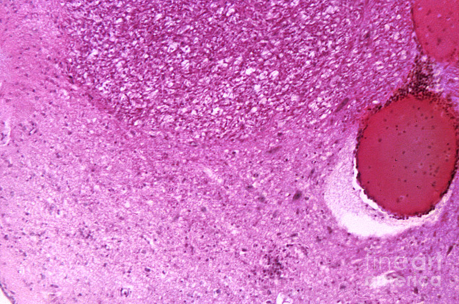 Type 3 Poliomyelitis, Brain Stem, Lm  by Science Source