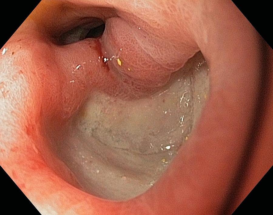 Endoscopy Photograph - Ulcer In The Duodenum by Gastrolab