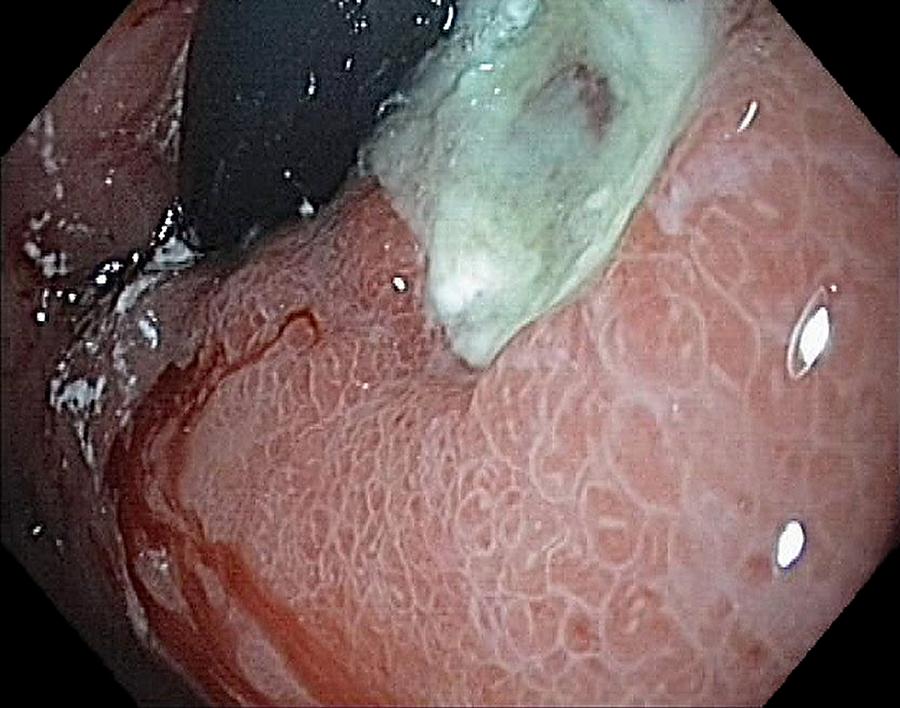 Endoscopy Photograph - Ulcerated Cancer In The Stomach by Gastrolab