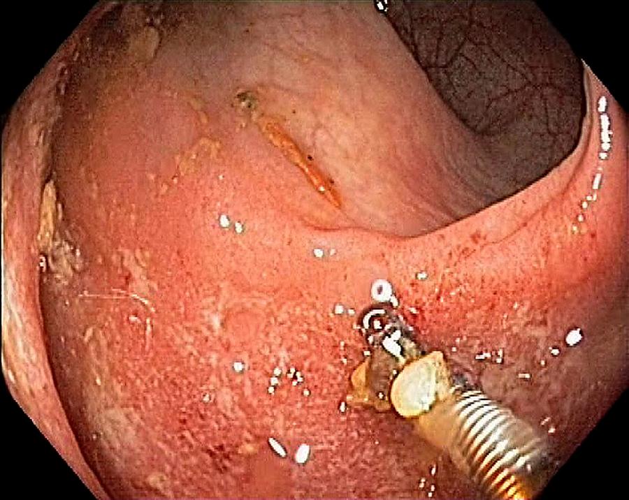 Endoscopy Photograph - Ulcerative Proctitis In The Rectum by Gastrolab