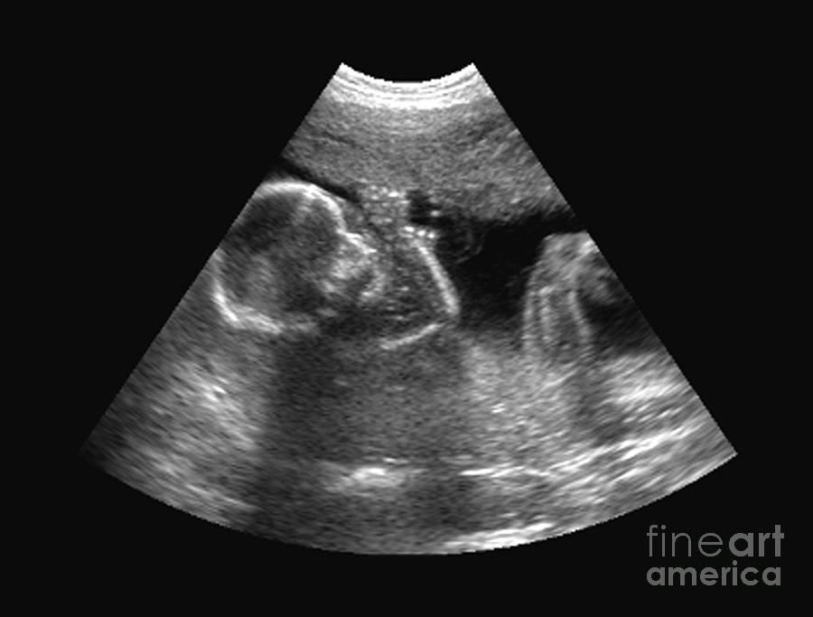 Ultrasound Of Fetus Photograph By Medical Body Scans Fine Art America