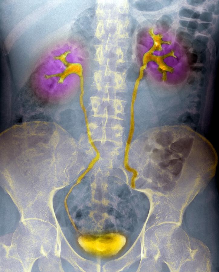 Urinary System X Ray Photograph By Du Cane Medical Imaging Ltd