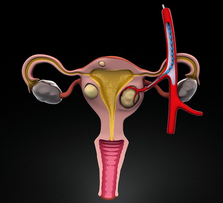 Uterine Fibroids Treatment Photograph By Jose Antonio PeÑas Fine Art