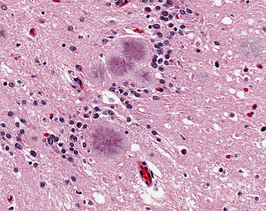 variant-creutzfeldt-jakob-disease-photograph-by-science-source-fine