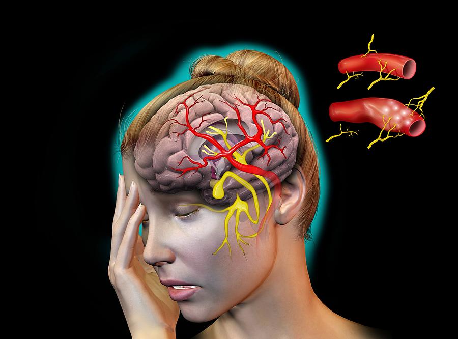 Headache Photograph - Vascular Causes Of Headaches by Jose Antonio PeÑas
