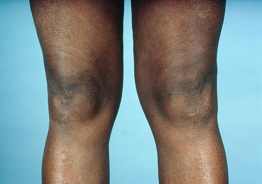 Arthritis Photograph - View Of Knees Affected By Osteoarthritis by 