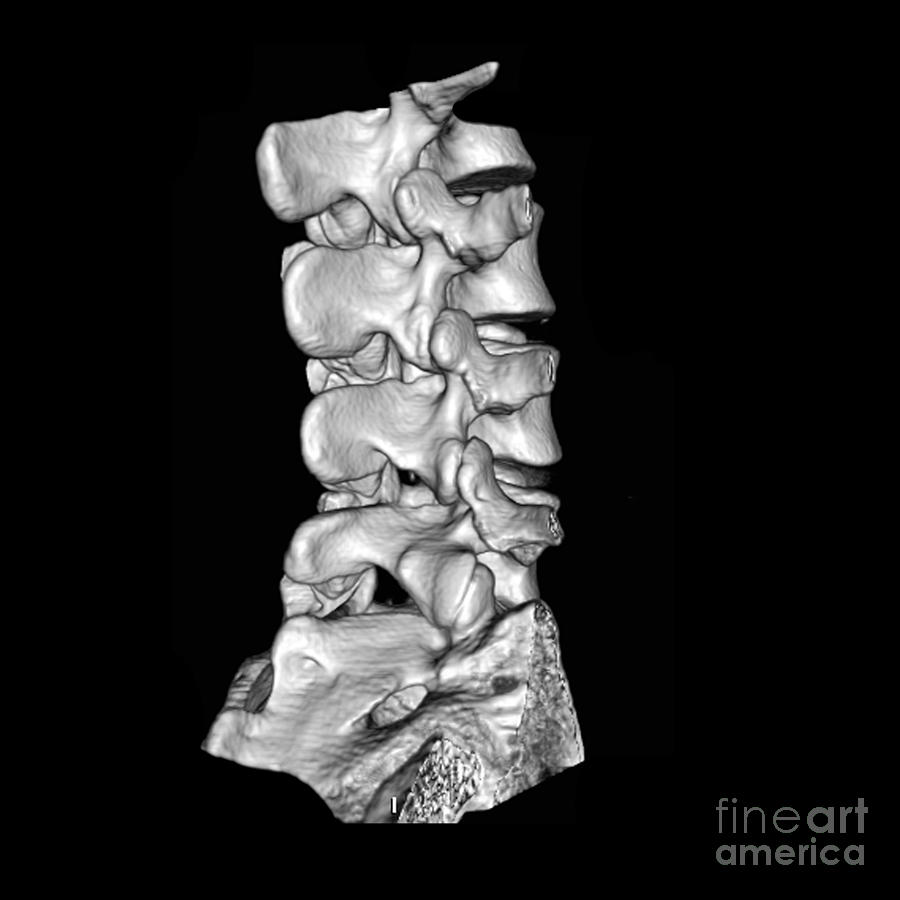 View Of Lumbar Spine Photograph by Medical Body Scans