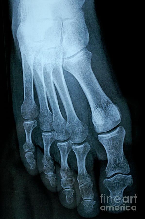 People Photograph - X-ray image of mature mans feet by Sami Sarkis