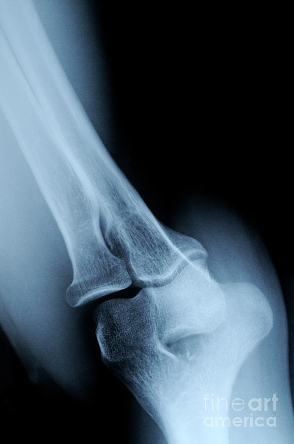 Elbow Photograph - X-ray image of matures man elbow by Sami Sarkis