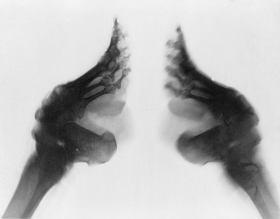 History Photograph - X-ray Of A Womans Bound Feet, China by Everett