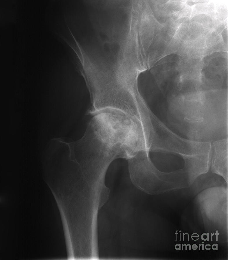 X-ray Of Arthritic Hip Photograph by Ted Kinsman