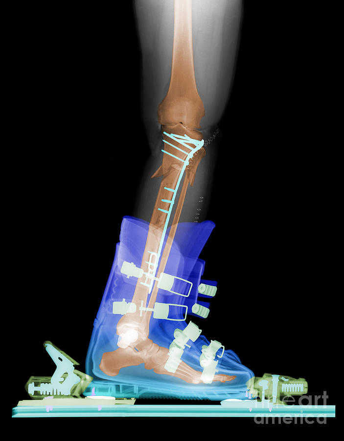 X-ray Of Broken Bones In Ski Boot Photograph by Ted Kinsman