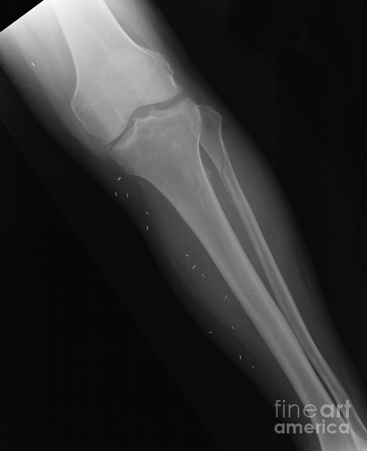 human broken leg x ray