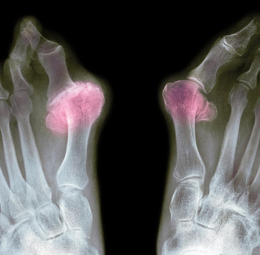 Feet Photograph - X-ray Of Bunions On The Toes by Mike Devlin