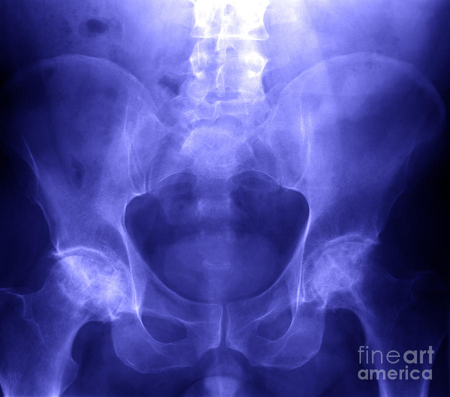 X-ray Of Compressed Lumbar Spine Photograph by Ted Kinsman