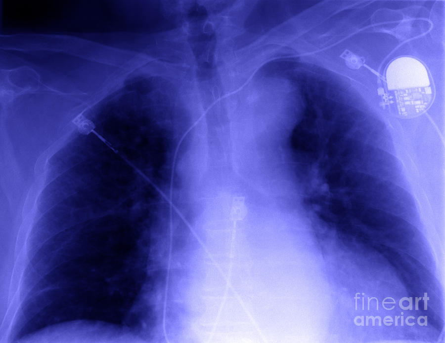 X-ray Of Implanted Defibulator Photograph by Ted Kinsman