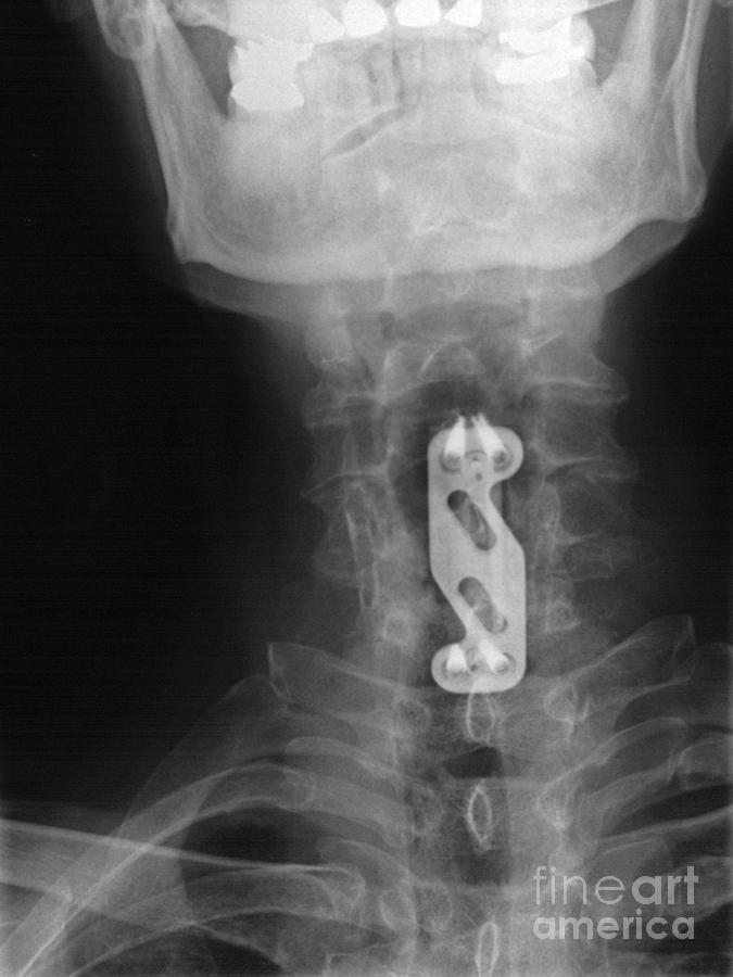 X-ray Of Neck Implant Photograph by Ted Kinsman