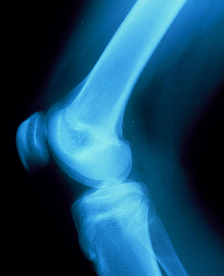 X-ray Of Normal Knee Joint Of 15-year-old Girl Photograph by 
