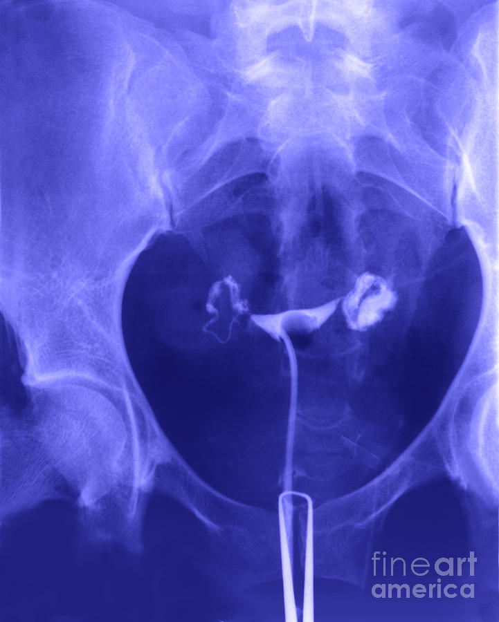 X-ray Of Ovaries Photograph by Ted Kinsman