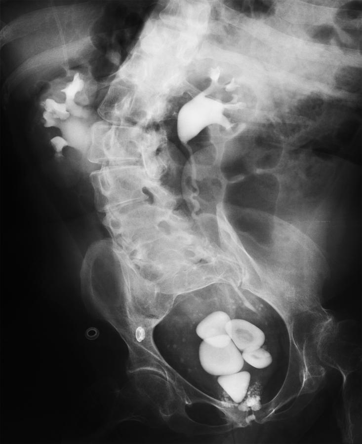 Black And White Photograph - X-ray Showing Bladder Stones by 