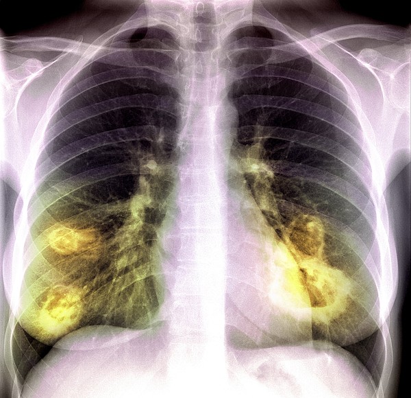 Lung Lesions, X-ray by Du Cane Medical Imaging Ltd