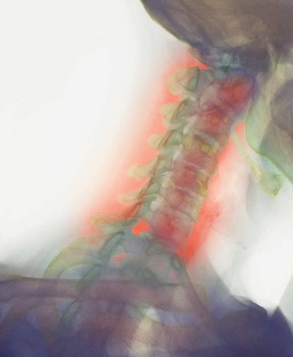 osteoarthritis neck
