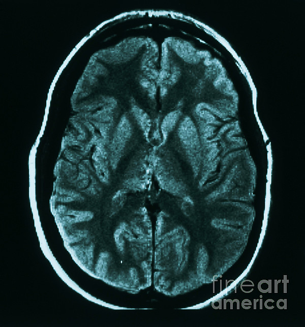 Mri Of Normal Brain #13 Tapestry by Science Source - Science Source Prints