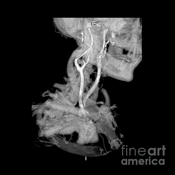 https://images.fineartamerica.com/images-medium/3-3d-cta-of-carotid-arteries-medical-body-scans.jpg