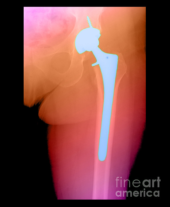 Hip Replacement #3 Throw Pillow by Medical Body Scans - Fine Art America