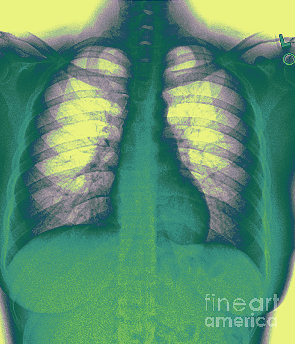 Chest X-ray - Copd And Scoliosis Throw Pillow by Medical Body Scans - Fine  Art America