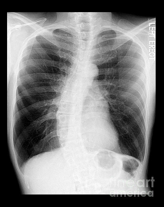 https://images.fineartamerica.com/images-medium/chest-x-ray-copd-and-scoliosis-medical-body-scans.jpg
