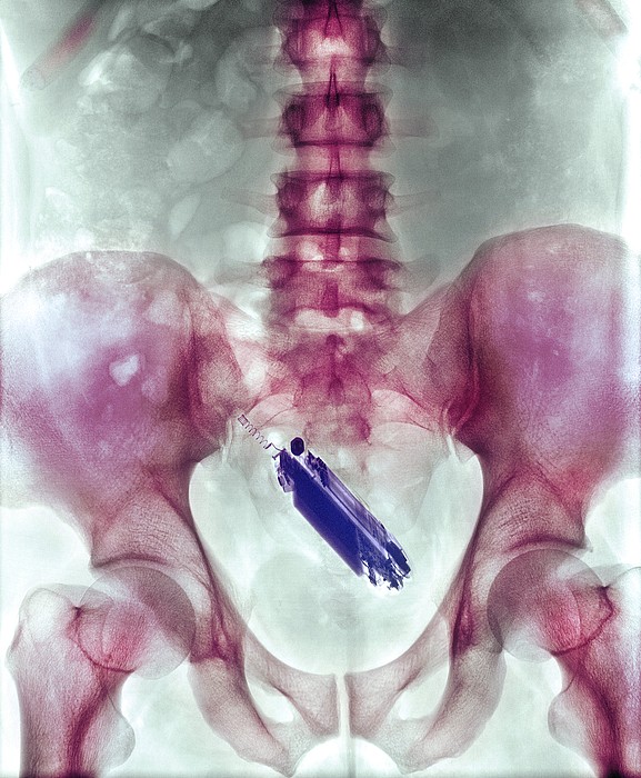Mobile Phone In A Person's Rectum, X-ray iPhone XR Case by - Pixels