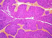 Bladder Cancer, Light Micrograph #1 Digital Art by Steve Gschmeissner