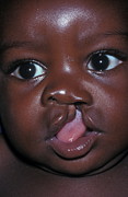 Cleft Lip #1 Photograph by Science Photo Library