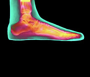 Coloured X-ray Of A Woman's Flat Foot #1 Photograph by Science Photo Library