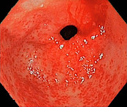 Gastric Antral Vascular Ectasia #1 Photograph by Science Photo Library