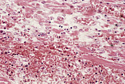 Heart Attack #1 Photograph by Science Photo Library