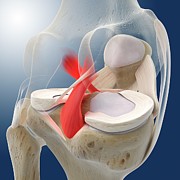Knee Pain #1 Photograph by Science Photo Library