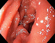 Lymphangiectasia In The Duodenum #1 Photograph by Science Photo Library