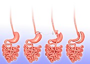 Weight Loss Surgery #1 Photograph by Science Photo Library