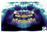 Emergence Of Adult Teeth #2 Photograph by Science Photo Library